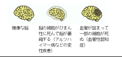 認知症とは Information 認知症の人と家族の会千葉県支部